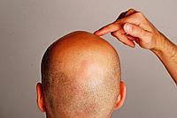 Hair Drugs (Хаир Драгс) - спрей для лечения мужской и женской алопеции