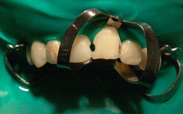 Restaurari dentare. - фото 1 - id-p19631
